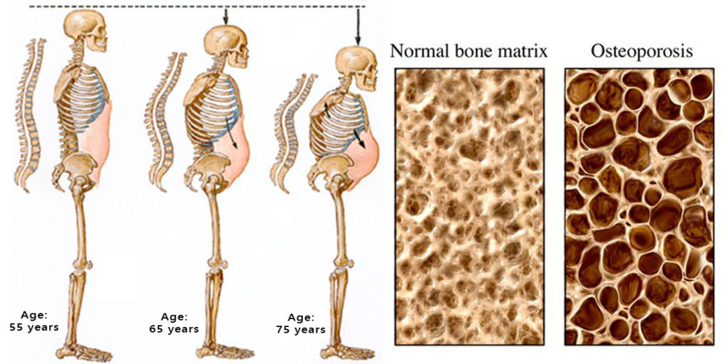 বয়স অনুসারে অস্টিওপরোসিস / Osteoporosis by age