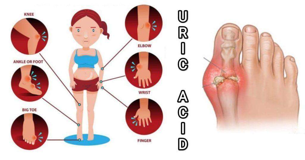 ইউরিক অ্যাসিড ব্যথার স্থান - Uric acid pain area